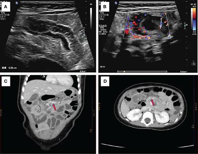 Transumbilical single-site laparoscopic treatment of small intestinal cavernous hemangioma in child: a case report